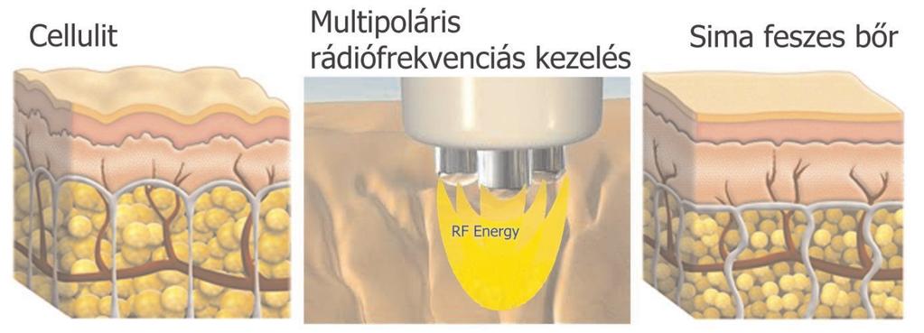 A rádiófrekvenciás zsírbontás A rádiófrekvencia kibocsátott elektromágneses hullámokból áll.