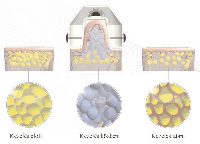 Arcideggyulladás, azaz trigeminus neuralgia - Dr. Zátrok Zsolt blog