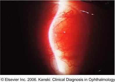 retina elvékonyodás teraligen látás