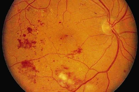 Szisztémás lupus erythematosus (SLE): Keratoconjunctivitis sicca Szemhéj- discoid lupus Diffúz anterior vagy nodularis scleritis Retina vasculitis- gyakori, cotton wool spot, diffúz arteriolaris