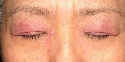 Dermatomyositis (DM): Szemhéj- Heliotrop rash Conjunctivitis