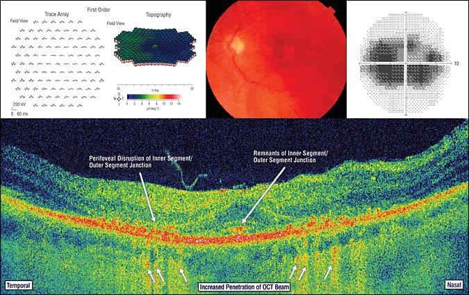 BULL S EYE MACULOPATHY Rodriguez-Padilla, J. A. et al.