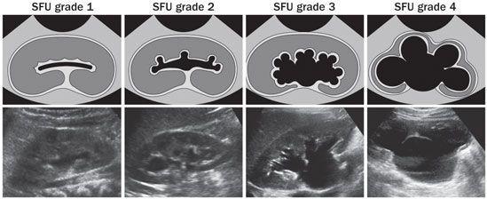 SFU (society of fetal urology) grading