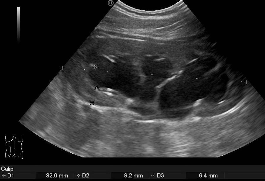PU stenosis Fiúk, bal oldal Leggyakoribb obstr uropathia Intrinsic ok: alulfejlett simaizom, aperistaltikus