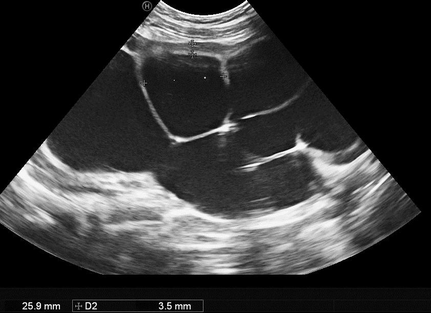 PU stenosis management OPUS: 24 mm