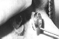 Lens/Search Coil