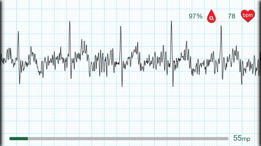 EKG mérés 60