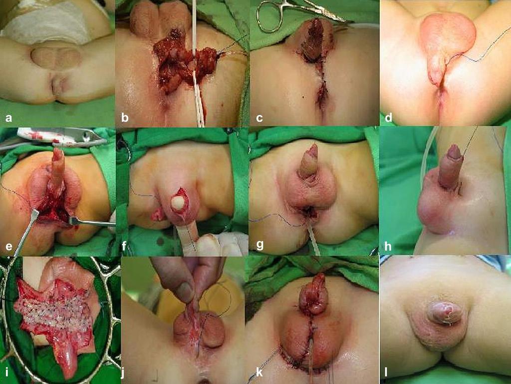 évesen. Másfél éves életkorban buccalis mucosaval végeztük el az urethra pótlását (harmadik lépcső), majd parciális urethra-plasztika történt a gyermek két éves életkorában (negyedik lépcső).