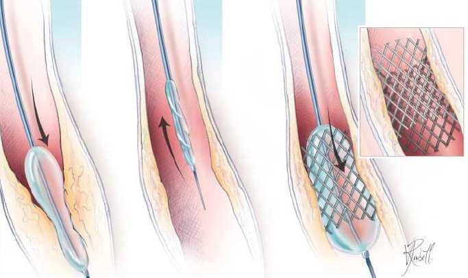 VII. Ajánlás carotis dissectio esetén [2] Ajánlás24 Carotisdissectioesetén az elsődleges terápia gyógyszeres antithromboticuskezelés (thrombocita aggregáció