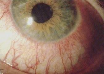 Tünetek: Ciliaris injectio Iris erei áteresztővé
