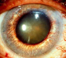 Rubeosis iridis Érújdonképződés az iris stromájában normálisan az iris nem tartalmaz látható ereket Mindig retinalis oxigénhiány jele retinalis érelzáródások proliferatív diabeteses retinopathia