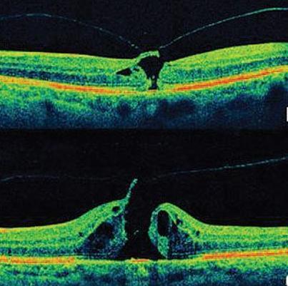 villámlátás retinaszakadás - retinaleválás - idejében