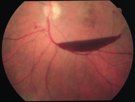 proliferatív diabeteses retinopahia retinalis érelzáródások