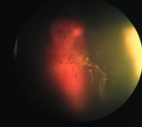 Terson syndroma (subarachnoidealis vérzés) UH: retina helyzete
