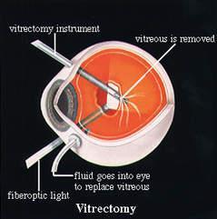 Vitrectomia A pars plana-n