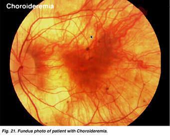 szegény diéta Chorioideremia -XR -Progresszív chorioidea és PE