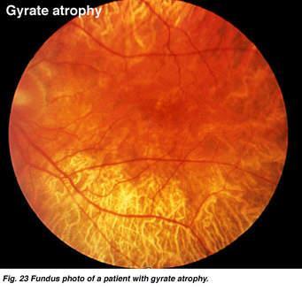 sokáig megőrzött -Myopia -CHM gén Génterápia (1.