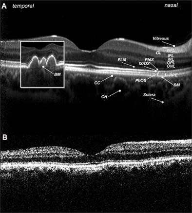 Lucentis: responderek Intact ELM in SD-OCT imaging is associated