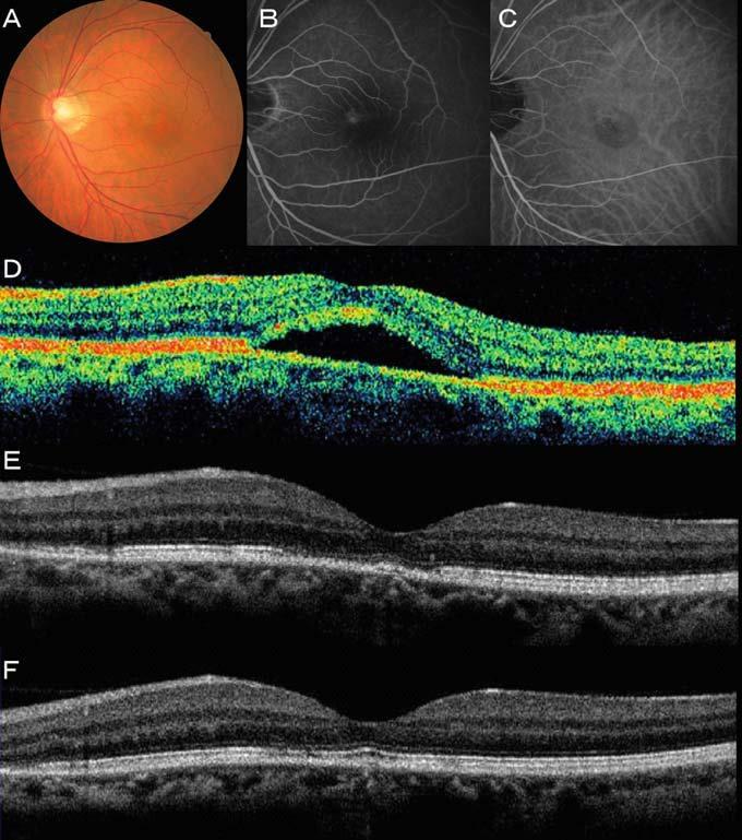 OJIMA Tudnak-e regenerálódni a Jpn J Ophthalmol 2010