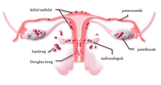 12. ábra: Az endometriotikus léziók leggyakoribb előfordulási helyei (forrás: www.sensiseeds.com). Az endometriális léziók kialakulásának okára több teória is született.