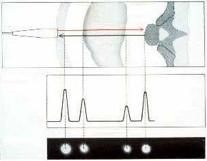 Eho elv, H képek Kétdimenziós B-kép transzduer pulzus mozgatott transzduer d ekhó B-mód