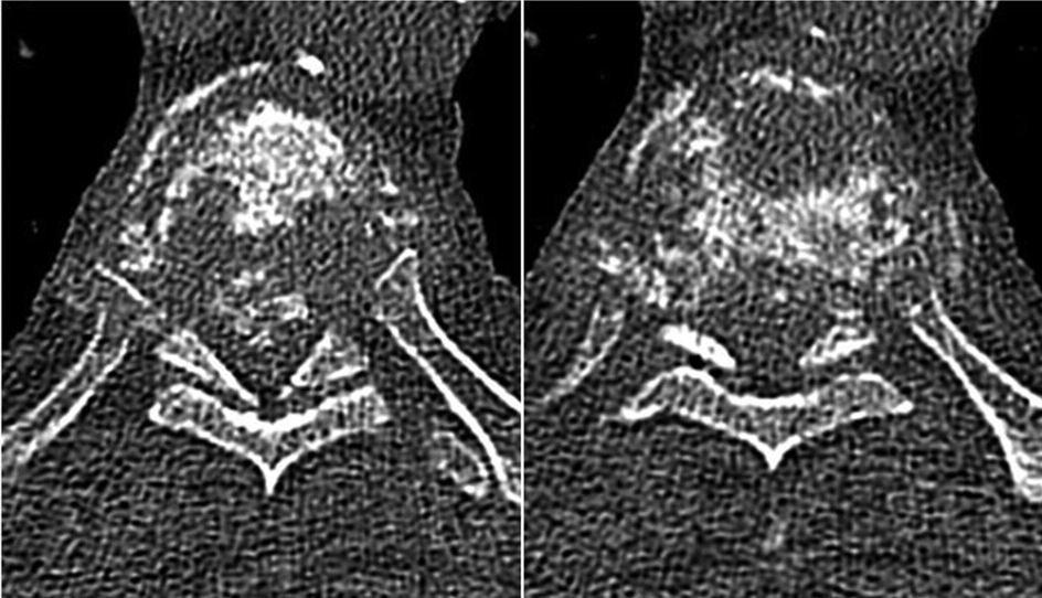 69. ábra. Súlyos canalis szűkülettel járó poroticus csigolyatörés axiális CT képe.