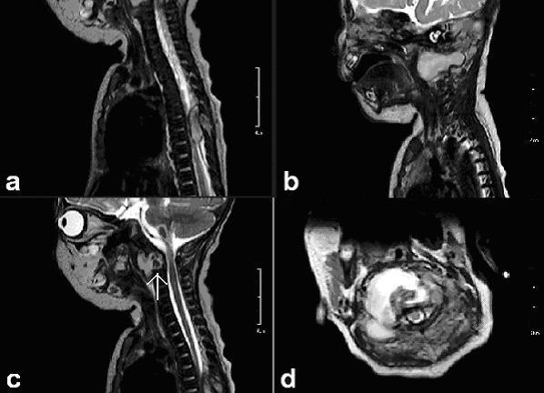 CI-II csigolya destrukcióját okozva (75. ábra). E mellett a ThV-VII magasságban myelonkompressziót okozó epidurális abscessus ábrázolódott.