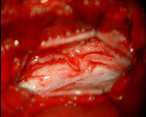 B 12. ábra. Műtéti kép a hemi-semi laminectomián keresztül és duranyitást követően (A, előző oldal) a tumor látótérbe kerülését, valamint az eltávolítása utáni állapotot mutatja (B).