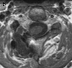 neuroblastoma fordul elő. A homokóratumorok leggyakrabban a nyaki gerincszakaszon találhatóak, ezt követi csökkenő gyakorisági sorrendben a háti és az ágyéki szakasz. A B 15. ábra.