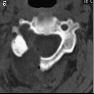 Hemi-semi laminectomiával kombinált szupraforaminális fúrt lyuk 3D CT felvételen.