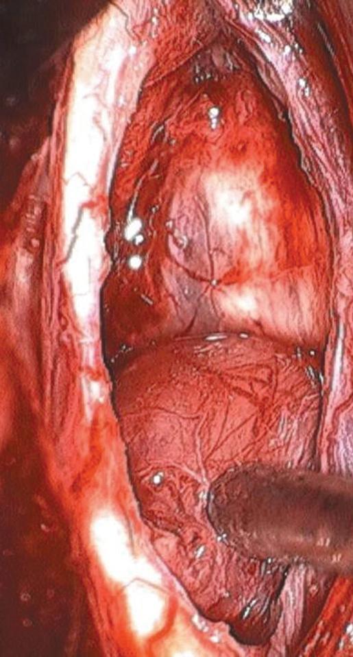 Hasonló alapelvet alkalmaztunk ependymomák és astrocytomák esetén. A cleavage felszín azonosításához először a tumor méretét intratumorálisan csökkentettük (debulking).