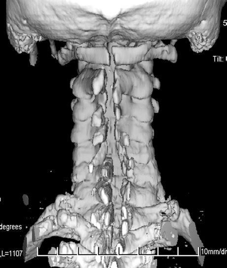 31. ábra. 3D CT rekonstrukciós felvételen a split laminotomia látható a nyaki és felső thoracalis gerincszakaszon. 32. ábra. A split és az ún.