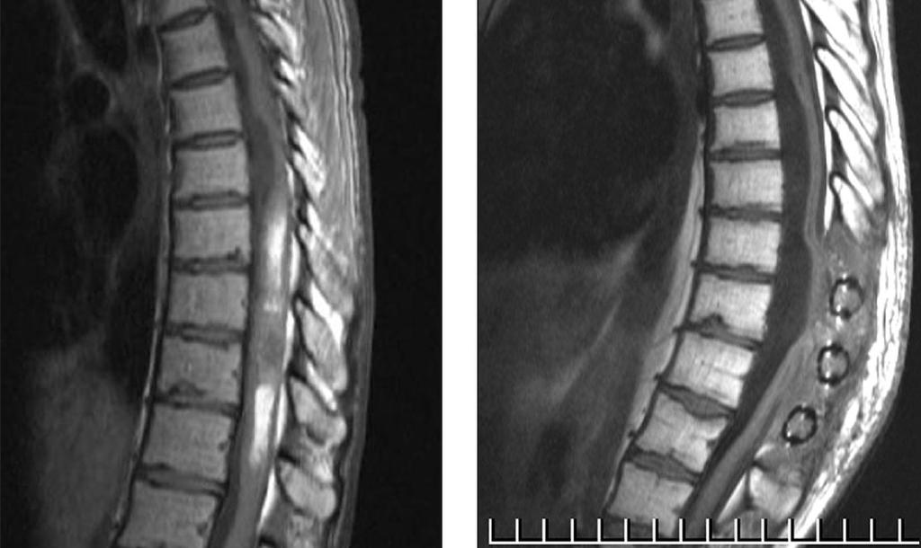 intramedulláris diffúz kontrasztanyag halmozó tumort mutat a CIV-VII szakaszon (A).