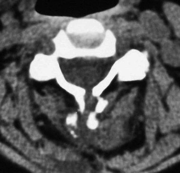 43. ábra. A posztoperatív axiális CT felvétel a processus spinosusok traumás törését mutatja. I/I/9.2.