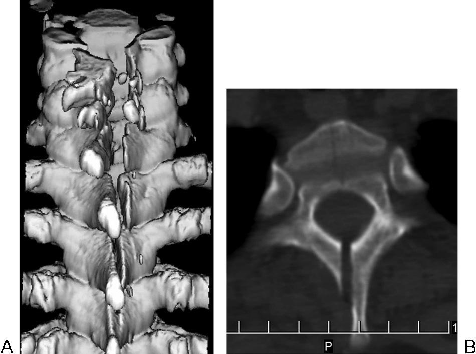 A B 49. ábra. 3D CT rekonstrukció (A) és axiális CT szelet (B) mutatja a para-split laminotomiát a felső háti szakaszon műtét után. A B 50. ábra. 3D CT rekonstrukció mutatja a többszinten végzett para-split laminotomiát a nyaki és felső háti szakaszon műtét után (A) és 3 évvel később (B).