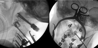 63. ábra. Az intraoperatív RTG a transzpediculáris vertebroplasztikát mutatja, AP (jobb) és oldalirányú (bal) nézetből, valamint a hátsó rögzítés csavarpárjai láthatóak. II/3.3. Eredmények Vizsgálatunkba 5 beteget választottunk be, 3 nőt és 2 férfit, akiknél osteolytikus CII metasztázis került felismerésre.