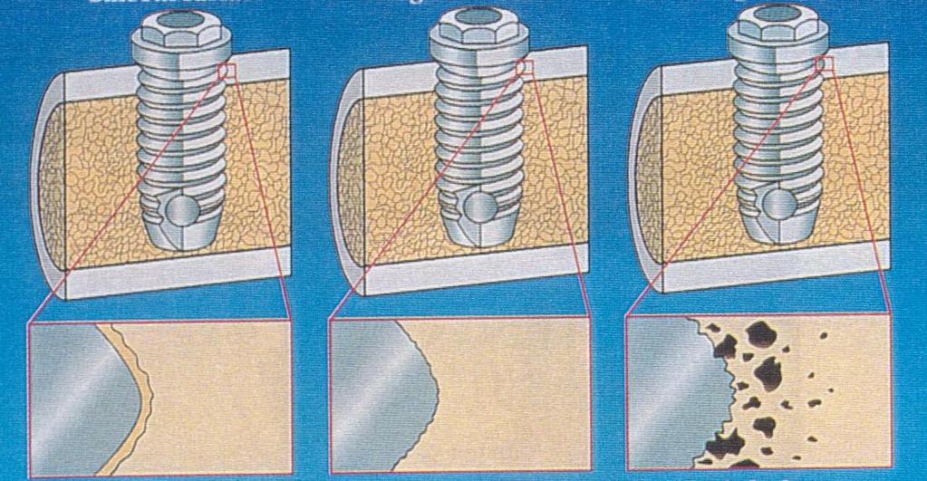 Irodalmi összefoglaló Implantátum felületének