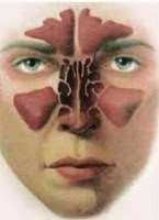 Allergic