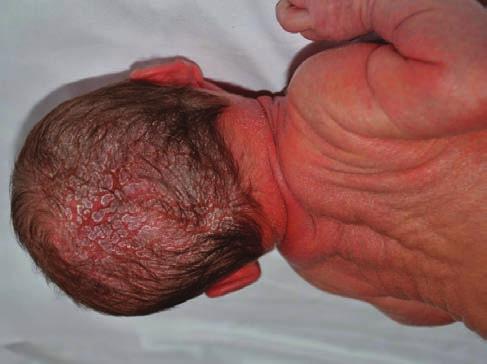 Neonatális erythrodermák Definíció szerint az erythroderma a bőrfelszín több, mint 90 %-os érintettségével járó, kiterjedt erythaemával és gyakran hámlással kísért gyulladásos reakció.