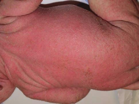 Hátterében azonban számos kiváltó ok és kórkép állhat: immunológiai betegségek, anyagcsere betegségek és nutricionális deficienciák, fertőzések, gyógyszer adverz reakciók, genodermatosisok,