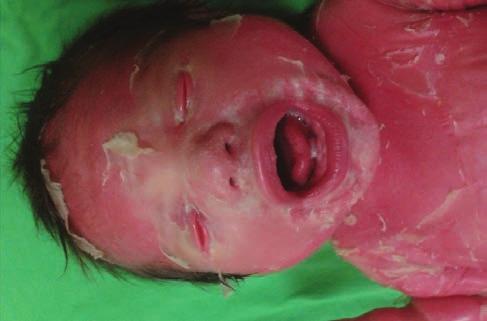 eredetű lymphocyták transzplacentáris átjutása is előidézheti immunkompetens újszülöttekben (ezen utóbbi esetben jóval enyhébb tünetek alakulnak ki, általában tranziens macularis exanthaema