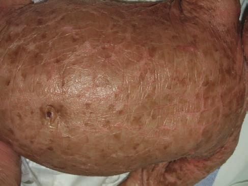 heti erythroderma is (5. ábra). A betegség autoszómális domináns öröklésmenetű, a KRT1 és KRT10 gének mutációja eredményezi.