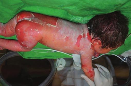 Harlequin ichthyosis A Harlequin-ichthyosis extrém súlyos elszarusodási zavarral járó klinikai entitás.