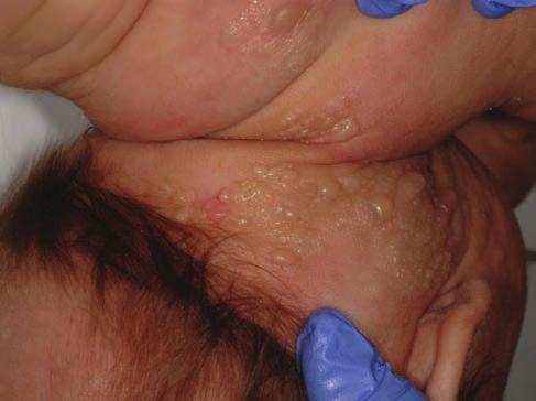 monális és gastrointestinalis mucosa) érintettsége különböző mértékű.