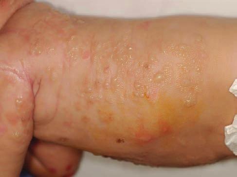 ellátás elengedhetetlen. Differenciál diagnosztikailag a Staphylococcus forrázott bőr szindrómától való elkülönítés lényeges: ez utóbbi lényegesen gyakrabban alakul ki az újszülött populációban.