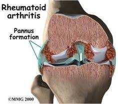 Rheumatoid arthritis- RA Az ízületi gyulladás gyakori. A betegek nem mindig tudják meg, melyik típusú arthritisükvan. A RA gyakori, krónikus szisztémás, fájdalmas gyulladásosbetegség.