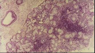 Sejtadhéziós molekulák fokozott illetve aberráns expressziója a glandularis epithelsejteken: lymphocytás infiltráció Lymphocytás infiltráció kisnyálmirigy biopsziában (HE festés, 50x) Infiltráló
