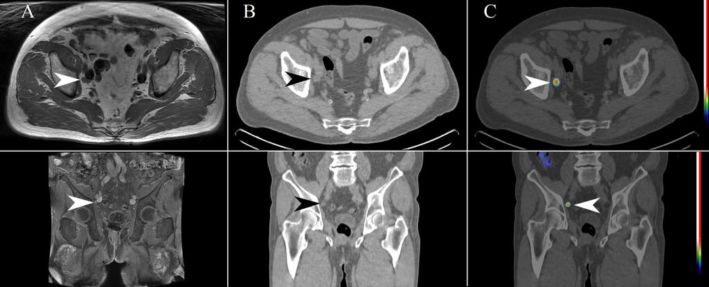 1. ábra 73 éves prosztatarákos férfi beteg, PSA: 1,2 ng/ml. Radikális prostatectomia után 2 évvel az emelkedett szérum-psa alapján a betegség progresszióját valószínűsítették.