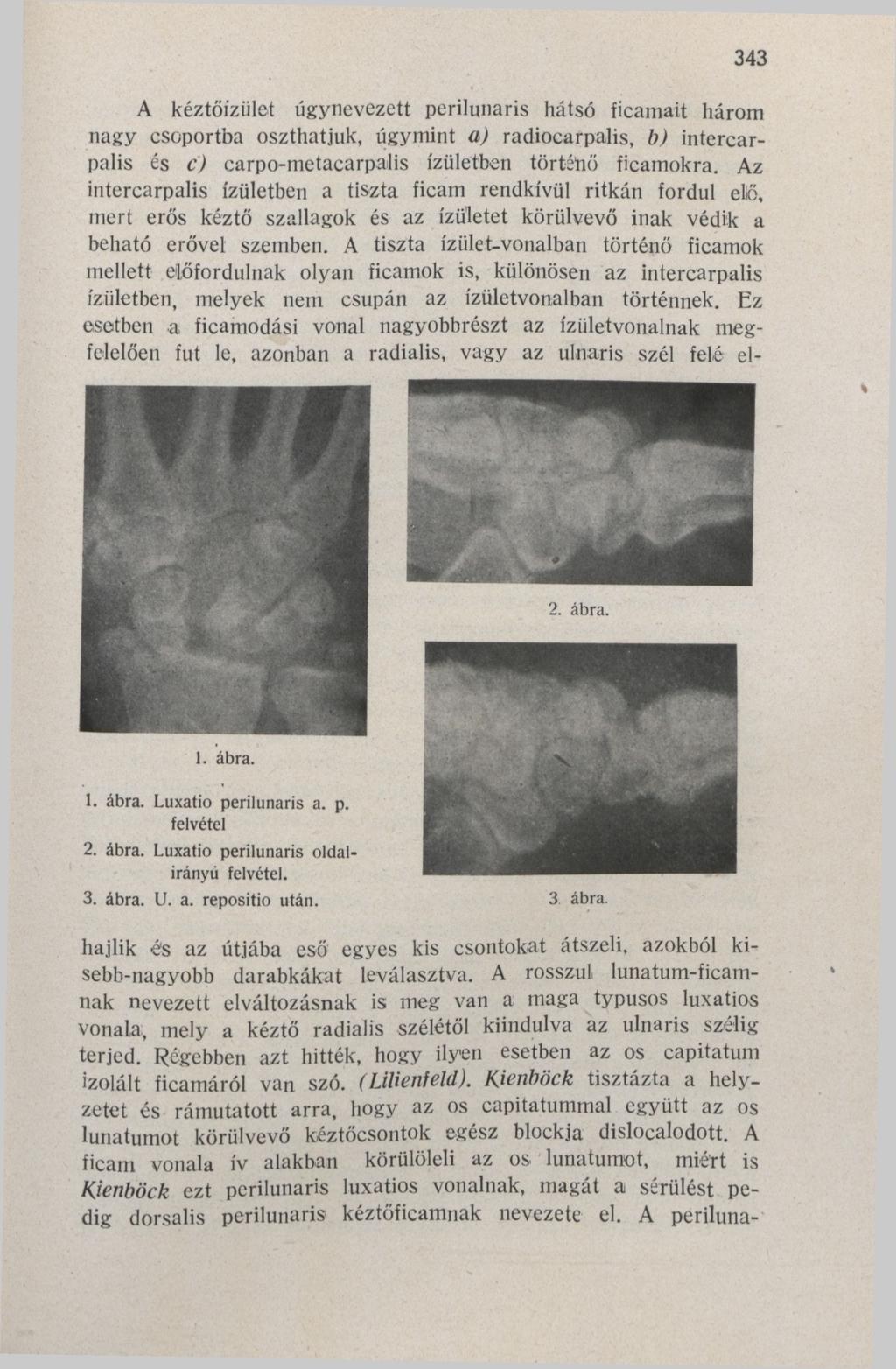 '343 A kéztőizület úgynevezett perilunaris hátsó ficamait három nagy csoportba oszthatjuk, úgymint a) radiocarpalis, b) intercarpalis és c) carpo-metacarpalis ízületben történő ficamokra.