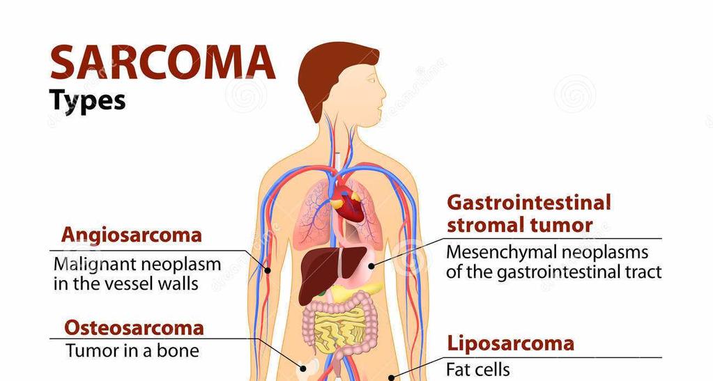 Végül a tumor áttétet képezve távoli szervekbe is elér, a nyirokutakon keresztül a nyirokcsomókba, az ereken keresztül a vérárammal bárhová.